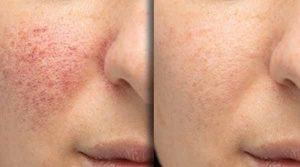 Key Benefits of CIMARE Barrier Repair Gel